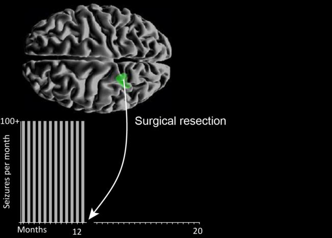 Depiction of the epilepsy source in the brain, and a graph showing seizures dropping off after intervention