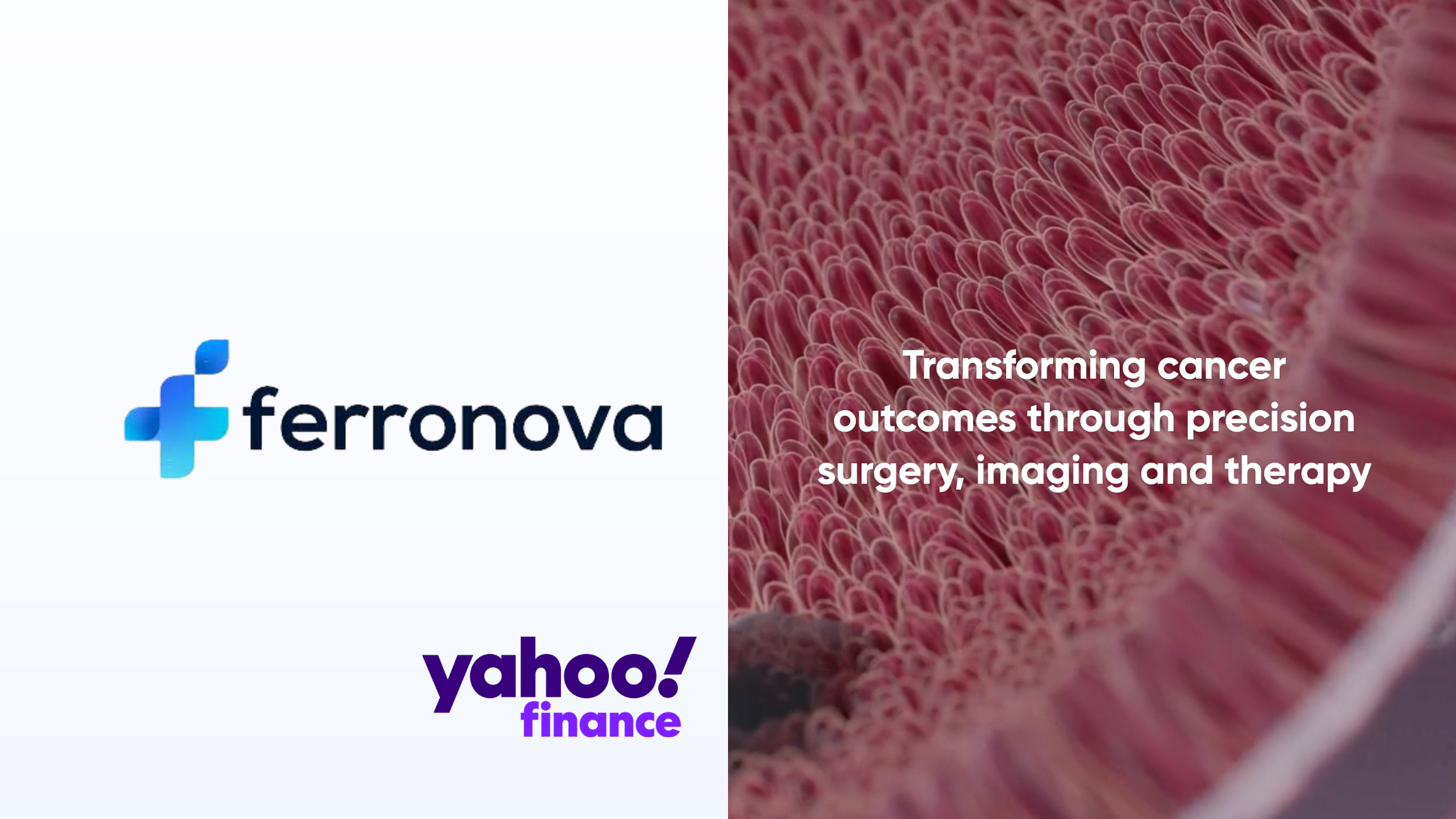 Yahoo Finance: Ferronova – Nanoparticle Trial Begins in Patients With Gastric and Oesophageal Cancers