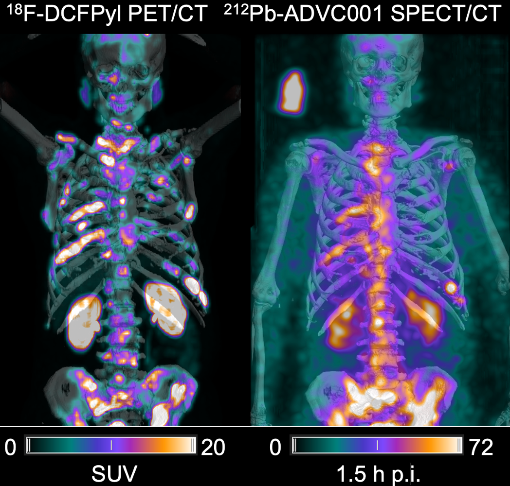 First in-human images of new hope treatment for poor-prognosis prostate cancer