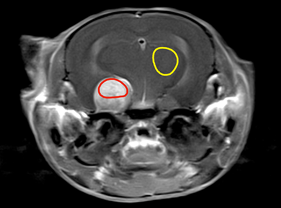 Imaging enabling nanomedicine to treat aggressive brain cancer