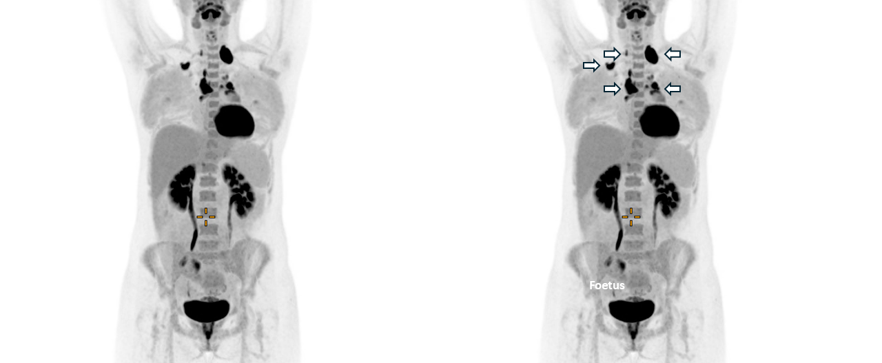 Early clinical research outcomes of the Total Body PET