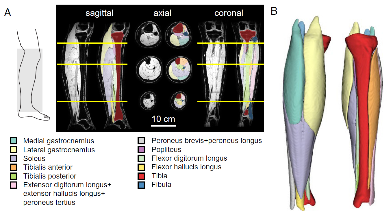 762 leg scans, 6 years: children with cerebral palsy set to benefit from huge MRI study