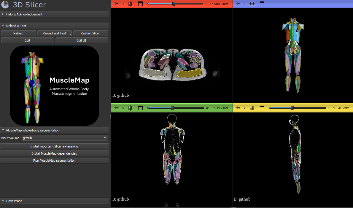From medical scans to muscle biomarkers: MuscleMap drives early disease detection