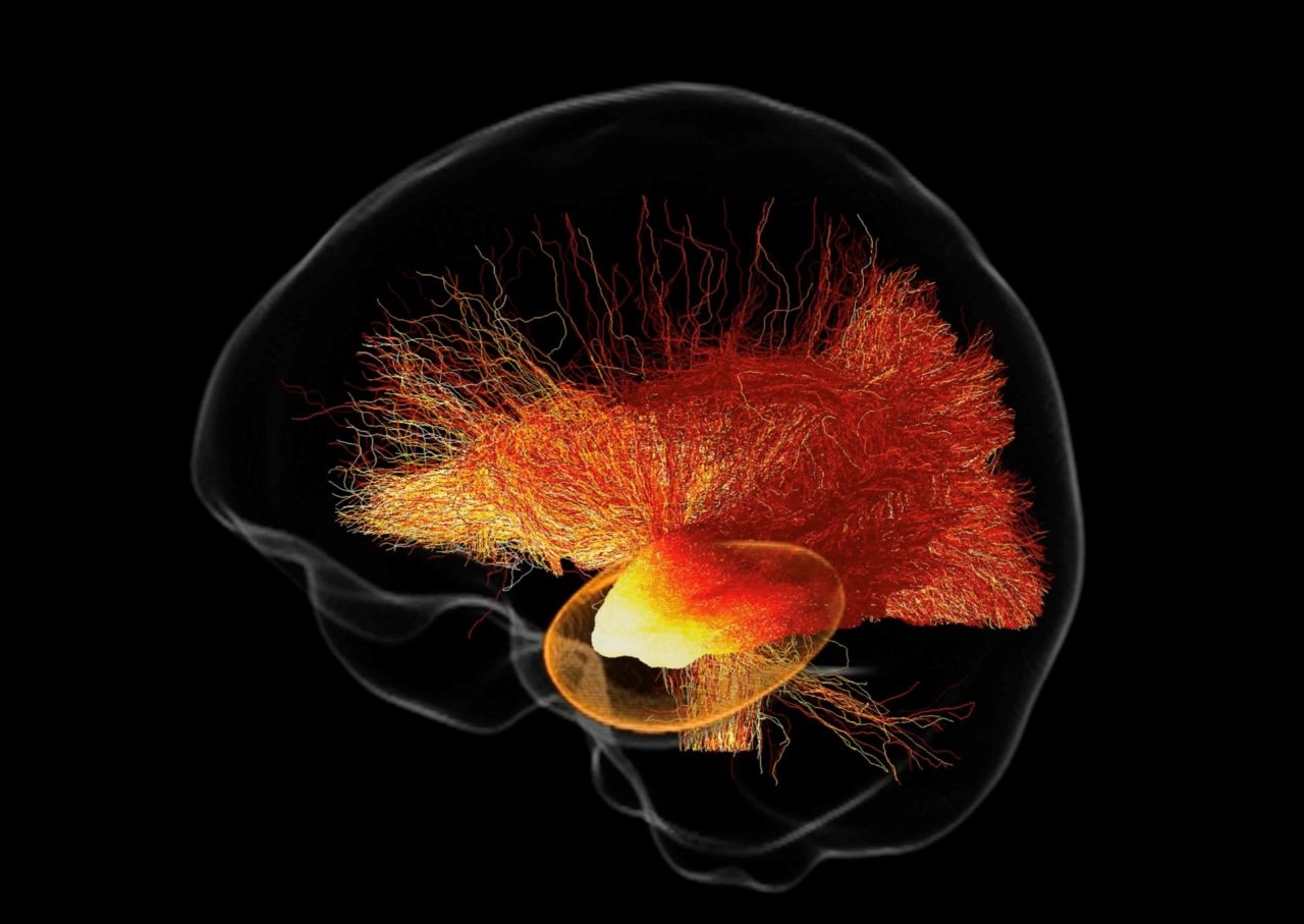 MRtrix3 software maps far-reaching structural effects of surgery in award-winning research