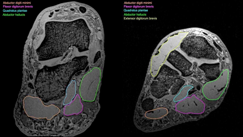 black and white MRI images showing a cross-section of the foot with deep foot muscles outlined in colour